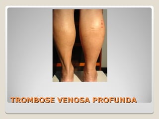 TROMBOSE VENOSA PROFUNDATROMBOSE VENOSA PROFUNDA
 
