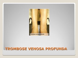 TROMBOSE VENOSA PROFUNDATROMBOSE VENOSA PROFUNDA
 