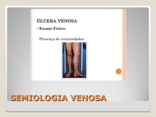 SEMIOLOGIA VENOSASEMIOLOGIA VENOSA
 