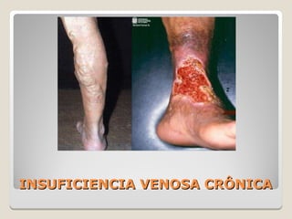 INSUFICIENCIA VENOSA CRÔNICAINSUFICIENCIA VENOSA CRÔNICA
 