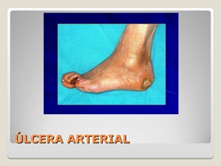 ÚLCERA ARTERIALÚLCERA ARTERIAL
 