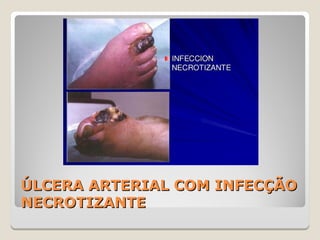 ÚLCERA ARTERIAL COM INFECÇÃOÚLCERA ARTERIAL COM INFECÇÃO
NECROTIZANTENECROTIZANTE
 