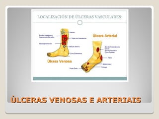 ÚLCERAS VENOSAS E ARTERIAISÚLCERAS VENOSAS E ARTERIAIS
 