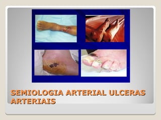 SEMIOLOGIA ARTERIAL ULCERASSEMIOLOGIA ARTERIAL ULCERAS
ARTERIAISARTERIAIS
 