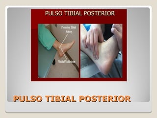 PULSO TIBIAL POSTERIORPULSO TIBIAL POSTERIOR
 