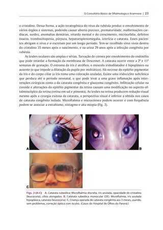 O Consultório Básico de Oftalmologia e Anamnese 23
o cristalino. Dessa forma, a ação teratogênica do vírus da rubéola produz o envolvimento de
vários órgãos e sistemas, podendo causar aborto precoce, prematuridade, malformações car­
díacas, surdez, anomalias dentárias, retardo mental e do crescimento, microcefalia, defeitos
ósseos, trombocitopenia, púrpura, hepatoesplenomegalia, icterícia e catarata. Esses pacien­
tes abrigam o vírus e o excretam por um longo período. Tem-se recolhido vírus vivos dentro
do cristalino 35 meses após o nascimento, e na urina 29 anos após a infecção congênita por
rubéola.
As lesões oculares são amplas e sérias. Turvação de córnea por envolvimento do endotélio
que pode retardar a formação da membrana de Descemet. A catarata ocorre entre a 2- e 1lâ
semanas de gestação. O estroma da íris é atrófico; o músculo iridodilatador é hipoplásico ou
ausente (o que impede a dilatação da pupila por midriático). Há necrose do epitélio pigmentar
da íris e do corpo ciliar (a íris toma uma coloração azulada). Existe uma iridociclite subclínica
que perdura até o período neonatal, o que pode levar a uma grave inflamação após inter­
venções cirúrgicas como a da catarata congênita e glaucoma congênito. Infiltração celular na
coroide e alterações do epitélio pigmentar da retina causam uma modificação no aspecto of-
talmoscópico da retina (retina em sal e pimenta). As lesões na retina produzem redução visual
mesmo após a cirurgia exitosa da catarata, a perspectiva visual é inferior a obtida nos casos
de catarata congênita isolada. Microftalmia e microcórnea podem ocorrer e com frequência
podem se associar a estrabismo, nistagmo e alta miopia (Fig. 2).
Figs. 2 (A-C) A. Catarata rubeólica: Microftalmia discreta, irís azulada, opacidade de cristalino
(leucocoria), cílios alongados. B. Catarata rubeólica monocular (OE). Microftalmia, irís azulada
hipoplásica, catarata (leucocoria). C. Criança operada de catarata congênita aos 3 meses, usando,
sem problemas, correção óptica com óculos. (Casos do Hospital de Olhos do Paraná.)
 
