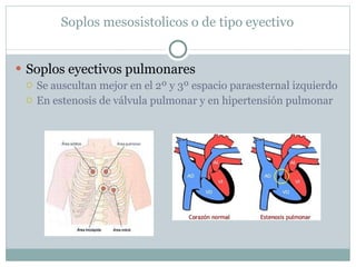 Soplos mesosistolicos o de tipo eyectivo Soplos eyectivos pulmonares Se auscultan mejor en el 2º y 3º espacio paraesternal izquierdo En estenosis de válvula pulmonar y en hipertensión pulmonar 