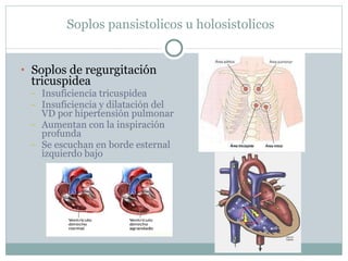 Soplos pansistolicos u holosistolicos Soplos de regurgitación tricuspidea Insuficiencia tricuspidea Insuficiencia y dilatación del VD por hipertensión pulmonar Aumentan con la inspiración profunda Se escuchan en borde esternal izquierdo bajo 
