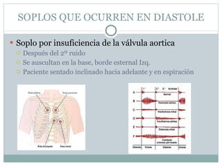 SOPLOS QUE OCURREN EN DIASTOLE Soplo por insuficiencia de la válvula aortica Después del 2º ruido Se auscultan en la base, borde esternal Izq.  Paciente sentado inclinado hacia adelante y en espiración 