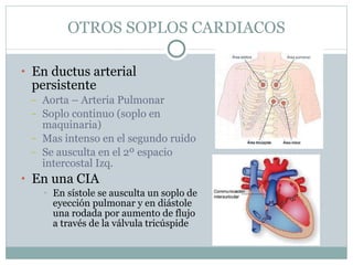 OTROS SOPLOS CARDIACOS En ductus arterial persistente Aorta – Arteria Pulmonar Soplo continuo (soplo en maquinaria) Mas intenso en el segundo ruido Se ausculta en el 2º espacio intercostal Izq. En una CIA En sístole se ausculta un soplo de eyección pulmonar y en diástole una rodada por aumento de flujo a través de la válvula tricúspide 