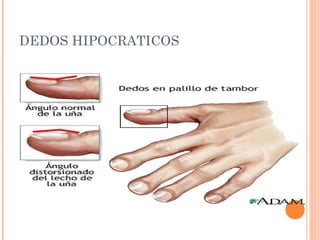 DEDOS HIPOCRATICOS
 
