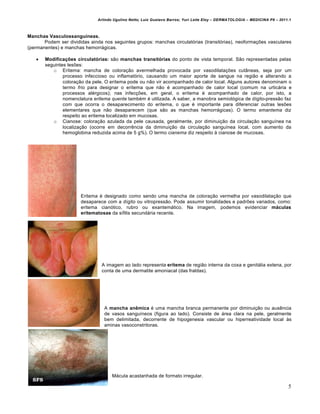 Arlindo Ugulino Netto; Luiz Gustavo Barros; Yuri Leite Eloy – DERMATOLOGIA – MEDICINA P8 – 2011.1



Manchas Vasculossanguíneas.
       Podem ser divididas ainda nos seguintes grupos: manchas circulatórias (transitórias), neoformações vasculares
(permanentes) e manchas hemorrágicas.

      Modificações circulatórias: são manchas transitórias do ponto de vista temporal. São representadas pelas
       seguintes lesões:
          o Eritema: mancha de coloração avermelhada provocada por vasodilatações cutâneas, seja por um
               processo infeccioso ou inflamatório, causando um maior aporte de sangue na região e alterando a
               coloração da pele. O eritema pode ou não vir acompanhado de calor local. Alguns autores denominam o
               termo frio para designar o eritema que não é acompanhado de calor local (comum na urticária e
               processos alérgicos); nas infecções, em geral, o eritema é acompanhado de calor, por isto, a
               nomenclatura eritema quente também é utilizada. A saber, a manobra semiológica de dígito-pressão faz
               com que ocorra o desaparecimento do eritema, o que é importante para diferenciar outras lesões
               elementares que não desaparecem (que são as manchas hemorrágicas). O termo emantema diz
               respeito ao eritema localizado em mucosas.
          o Cianose: coloração azulada da pele causada, geralmente, por diminuição da circulação sanguínea na
               localização (ocorre em decorrência da diminuição da circulação sanguínea local, com aumento da
               hemoglobina reduzida acima de 5 g%). O termo cianema diz respeito à cianose de mucosas.




                       Eritema é designado como sendo uma mancha de coloração vermelha por vasodilatação que
                       desaparece com a dígito ou vitropressão. Pode assumir tonalidades e padrões variados, como:
                       eritema cianótico, rubro ou exantemático. Na imagem, podemos evidenciar máculas
                       eritematosas da sífilis secundária recente.




                                A imagem ao lado representa eritema de região interna da coxa e genitália extena, por
                                conta de uma dermatite amoniacal (das fraldas).




                                 A mancha anêmica é uma mancha branca permanente por diminuição ou ausência
                                 de vasos sanguíneos (figura ao lado). Consiste de área clara na pele, geralmente
                                 bem delimitada, decorrente de hipogenesia vascular ou hiperreatividade local às
                                 aminas vasoconstritoras.




                                     Mácula acastanhada de formato irregular.

                                                                                                                             5
 