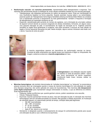Arlindo Ugulino Netto; Luiz Gustavo Barros; Yuri Leite Eloy – DERMATOLOGIA – MEDICINA P8 – 2011.1


   Neoformação vascular: s•o manchas permanentes, representadas pelas telangiectasias e angiomas. Tais
    manchas s•o permanentes devido Š instala€•o de novas c‚lulas endoteliais dotadas de uma neovasculariza€•o.
       o Telangiectasias: s•o dilata€†es permanentes do calibre de pequenos vasos. Pode ser manifesta€•o de
          uma insufici‰ncia hep…tica na forma adquirida. Quando acomete mucosa labial e as extremidades,
          possƒvel quadro de Telangiectasia hemorr…gica heredit…ria (Doen€a de Rendu-Osler-Weber) se complica
          com a hipertens•o pulmonar e sangramento do trato gastrointestinal. Tamb‚m ‚ frequente a forma€•o
          de telangiectasia por exposi€•o excessiva ao sol.
       o Angiomas: caracterizada pelo aumento do nˆmero de capilares, com a forma€•o de uma les•o cut‡nea
          de aspecto tumoral (devido ao acˆmulo exagerado de c‚lulas endoteliais), formando, em alguns casos,
          uma pequena eleva€•o da pele. O acometimento da regi•o de inerva€•o do N. Trig‰meo (mancha
          vermelha na regi•o face) geralmente ‚ cong‰nita; mas pode acontecer o acˆmulo de mais c‚lulas na
          regi•o e formar pequenas eleva€†es da pele. Nesta situa€•o, alguns autores intitularam esta les•o com
          o termo “mancha do vinho do porto”.




                      A mancha angiomatosa aparece em decorr‰ncia de neoforma€•o vascular na derme.
                      Consiste de les•o eritematosa que regride quase que totalmente Š digito ou vitropress•o. Na
                      imagem, podemos evidenciar a mancha angiomatosa em face.




                                                                    A telangiectasia ‚ uma dilata€•o vascular capilar
                                                                    (de art‚rias ou veias de pequeno calibre - menor
                                                                    que 2mm) permanente na derme superficial,
                                                                    constituindo les•o linear, sinuosa, estelar ou
                                                                    puntiforme.


   Manchas hemorrágicas: s•o tamb‚m denominadas de “sufus†es hemorr…gicas” ou “pˆrpuras” (a nomenclatura
    pˆrpura somente deve ser empregada quando a causa da mancha hemorr…gica for uma altera€•o do capilar
    e/ou discrasia sanguƒnea, n•o sendo aplicada em casos de traumatismos). Tais manchas não desaparecem
    coma dígito-compressão (pois representam sangue extravasado no tecido), o que as diferencia do eritema.
    Suas representantes s•o:
        o Pet‚quias: les†es puntiformes que, quando ganham volume, podem caracterizar uma vasculite.
        o Vƒbices: Pet‚quias lineares.
        o Equimose: Quando apresentam formato de placa, mas sem eleva€•o da pele. A colora€•o das manchas
            hemorr…gicas varia de vermelho-arroxeado ao amarelo. Nas grandes e m‚dias equimoses, as mudan€as
            de colora€•o seguem um determinado perƒodo de tempo, condi€•o dada pela fagocitose.
                o At‚ 48h: avermelhadas.
                o 48h – 96h: arroxeadas.
                o 5• - 6• dia: azuladas.
                o 6 – 8• dia: amareladas.
                o Ap„s 9• dia: retorno a cor normal.
        o Hematoma: ‚ designado quando o extravasamento de sangue foi suficientemente grande para causar
            uma eleva€•o da pele (o que o diferencia da equimose).




                                                                                                                         6
 