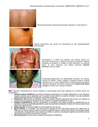 Arlindo Ugulino Netto; Luiz Gustavo Barros; Yuri Leite Eloy – DERMATOLOGIA – MEDICINA P8 – 2011.1




                                              Manchas pigmentares hipocr‹micas (pitirƒase versicolor ou “pano branco”).




                                        Mancha hipocr‹mica que ocorreu em decorr‰ncia de uma hipopigmenta€•o
                                        (pitirƒase Alba).




                                                     Leucodermia ‚ o termo que designa uma mancha branca por
                                                     diminui€•o (hipocromia) ou aus‰ncia (acromia) de pigmento mel‡nico
                                                     (melanina) na epiderme. A imagem ao lado demonstra um paciente
                                                     jovem, do sexo masculino, com les†es acr‹micas (mancha
                                                     acrômica), tƒpica do vitiligo.




                                                      A hiperpigmenta€•o pode ser generalizada (sƒndrome de Cushing,
                                                      Doen€a de Addison, porfiria, pelagra), localizada (cloasma, eritema
                                                      pigmentar fixo) ou com espessamento ou hiperqueratose associados
                                                      (acantose nigricante). Na imagem, observamos a hipercromia difusa
                                                      da pele, em mulher com doen€a de Addison


     2
OBS : Algumas nomenclaturas ou termos utilizados na dermatologia para tipos especiais de manchas devem ser
considerados:
     Exantema (eritema mobiliforme): diz respeito Š altera€•o caracterizada por um eritema disseminado no corpo. Mostra-se
        naqueles pacientes que se apresentam com boa parte da pele coberta por manchas vermelhas, mas que apresentam
        regi†es de colora€•o normal. Ž caracterƒstico, por exemplo, do sarampo.
     Eritrodermia: diferentemente do exantema, constitui a colora€•o vermelha praticamente total da pele, com aus‰ncia ou
        presen€a de poucas …reas de colora€•o normal. Ž, portanto, um exantema generalizado do corpo.
     Exantema escarlatiniforme: manchas caracterƒsticas da escarlatina, uma doen€a causada por estreptococos que se
        manifesta na forma de vermelhid•o generalizada na pele acompanhada de altera€†es na textura da mesma (a pele torna-se
        …spera, com aspecto de lixa).
     Eritema figurado: s•o …reas vermelhas com bordas salientes e bem visƒveis.
     Mancha anêmica: ‚, na verdade, uma mancha branca causada por uma malforma€•o vascular local. Diferencia-se do
        vitiligo pois, na mancha an‰mica, quando se comprime a regi•o da mancha, a …rea ao redor diminui a sua colora€•o e passa
        a se apresentar, temporariamente, com a mesma cor an‰mica. Ž, portanto, uma situa€•o cong‰nita e que tamb‚m pode ser
        chamada de nevus anêmico (ou sinal branco da pele).
     Nevus hipocrƒmico: mancha branca causada por diminui€•o dos melan„citos.

                                                                                                                                 8
 