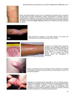 Arlindo Ugulino Netto; Luiz Gustavo Barros; Yuri Leite Eloy – DERMATOLOGIA – MEDICINA P8 – 2011.1




Placas, s•o les†es elevadas, maiores que 1cm, geralmente de superfƒcie plana. A superfƒcie
da placa pode ser tamb‚m descamativa, crostosa, queratinizada ou macerada. Pode ser
constituƒda pela conflu‰ncia de v…rias p…pulas (placa papulosa). O termo “placa” tamb‚m ‚
empregado para a conflu‰ncia de m…culas, sendo ent•o denominada a les•o placa maculosa.
Na imagem, evidenciamos placas extensas resultantes da conflu‰ncia de les†es papulosas
de urtic…ria.




                 Les•o tuberosa ou tub‚rculo. Ž uma les•o elevada e que evolui com
                 cicatriza€•o, sendo caracterƒstica da tuberculose cut‡nea.




                                                    O n„dulo ‚ um infiltrado s„lido circunscrito,
                                                    geralmente bem delimitado, persistente, de
                                                    localiza€•o d‚rmica ou hipod‚rmica, podendo
                                                    ser elevado ou situado profundamente na
                                                    derme, medindo 1 a 3 cm de di‡metro.
                                                    Costuma ser mais palp…vel que visƒvel
                                                    (embora     possa    ser   n•o-palp…vel     e
                                                    subcut‡neo).




               Goma ‚ um n„dulo ou tumor que se liquefaz no centro, drenando, por ulcera€•o
               ou fistuliza€•o, subst‡ncia que varia conforme o processo b…sico. Ž comum na
               tuberculose ganglionar.




               Vegeta€•o ‚ uma p…pula elevada, pediculada ou n•o, de superfƒcie irregular,
               ocasionalmente sangrante. Pode ser recoberta por superfƒcie querat„sica dura,
               inel…stica e amarelada, recebendo o nome de verrucosidade ou les•o
               verrucosa. As verrugas vulgares tamb‚m podem ser classificadas como
               vegeta€†es. Contudo, quando a vegeta€•o se localiza em mucosas, ‚ chamada
               de les•o condilomatosa ou condilomas (verrugas genitais).

                                                                                                    10
 