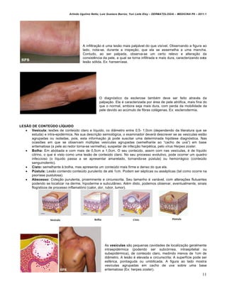 Arlindo Ugulino Netto; Luiz Gustavo Barros; Yuri Leite Eloy – DERMATOLOGIA – MEDICINA P8 – 2011.1




                                       A infiltra€•o ‚ uma les•o mais palp…vel do que visƒvel. Observando a figura ao
                                       lado, nota-se, durante a inspe€•o, que ela se assemelha a uma mancha.
                                       Contudo, ao ser palpada, observa-se um certo relevo e altera€•o da
                                       consist‰ncia da pele, a qual se torna infiltrada e mais dura, caracterizando esta
                                       les•o s„lida. Ex: hansenƒase.




                                                   O diagn„stico da esclerose tamb‚m deve ser feito atrav‚s da
                                                   palpa€•o. Ela ‚ caracterizada por …rea de pele atr„fica, mais fina do
                                                   que o normal, embora seja mais dura, com perda da mobilidade da
                                                   pele devido ao acˆmulo de fibras col…genas. Ex: esclerodermia.



LESÃO DE CONTEÚDO LÍQUIDO
    Vesícula: les†es de conteˆdo claro e lƒquido, co di‡metro entre 0,5- 1,0cm (dependendo da literatura que se
      estuda) e intra-epid‚rmica. Na sua descri€•o semiol„gica, o examinador dever… descrever se as vesƒculas est•o
      agrupadas ou isoladas, pois, esta informa€•o j… pode suscitar uma determinada hip„tese diagn„stica. Nas
      ocasi†es em que se observam mˆltiplas vesƒculas agrupadas (semelhante ao “cacho de uva”) em base
      eritematosa (a pele ao redor torna-se vermelha), suspeitar de infec€•o herp‚tica, pelo vƒrus Herpes zoster.
    Bolha: Em ab„bada e com mais de 0,5cm a 1,0cm. O seu conteˆdo, assim com nas vesƒculas, ‚ de lƒquido
      citrino, o que ‚ visto como uma les•o de conteˆdo claro. No seu processo evolutivo, pode ocorrer um quadro
      infeccioso (o lƒquido passa a se apresentar amarelado, tornando-se pˆstula) ou hemorr…gico (conteˆdo
      sanguinolento).
    Cisto: semelhante Š bolha, mas apresenta um conteˆdo mais firme e denso do que ela.
    Pústula: Les•o contendo conteˆdo purulento de at‚ 1cm. Podem ser s‚pticas ou ass‚pticas (tal como ocorre na
      psorƒase pustulosa).
    Abscesso: Cole€•o purulenta, proeminente e circunscrita. Seu tamanho ‚ vari…vel, com altera€†es flutuantes
      podendo se localizar na derme, hipoderme e subcut‡neo. Al‚m disto, podemos observar, eventualmente, sinais
      flogƒsticos de processo inflamat„rio (calor, dor, rubor, tumor).




                                                       As vesículas s•o pequenas cavidades de localiza€•o geralmente
                                                       intraepid‚rmica (podendo ser subc„rnea, intraepitelial ou
                                                       subepid‚rmica), de conteˆdo claro, medindo menos de 1cm de
                                                       di‡metro. A les•o ‚ elevada e circunscrita. A superfƒcie pode ser
                                                       esf‚rica, pontiaguda ou umbilicada. A figura ao lado mostra
                                                       vesƒculas agrupadas em cacho de uva sobre uma base
                                                       eritematosa (Ex: herpes zoster).
                                                                                                                            11
 