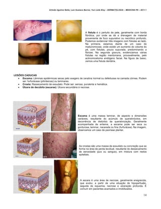Arlindo Ugulino Netto; Luiz Gustavo Barros; Yuri Leite Eloy – DERMATOLOGIA – MEDICINA P8 – 2011.1




                                                                A fístula é o pertuito da pele, geralmente com borda
                                                                fibrótica, por onde se dá a drenagem de material
                                                                proveniente de foco supurativo ou necrótico profundo.
                                                                Podemos evidenciar três imagens com fístulas ao lado.
                                                                Na primeira, estamos diante de um caso de
                                                                maduromicose, onde existe um aumento do volume do
                                                                pé, com fístulas, pouco supurada, predominando a
                                                                fibrose. Na segunda gravura, evidenciamos várias
                                                                fístulas na região mentoniana, provavelmente, pelo
                                                                actinomicetoma endógeno facial. Na figura de baixo,
                                                                vemos uma fístula dentária.




LESÕES CADUCAS
    Escama: Lâminas epidérmicas secas pelo exagero de ceratina normal ou defeituosa na camada córnea. Podem
     ser: furfuráceas (pitiriásicas) ou laminares.
    Crosta: Ressecamento de exsudato. Pode ser: serosa, purulenta e hemática.
    Úlcera de decúbito (escaras): Úlcera secundária à necrose.




                                                        Escama é uma massa laminar, de aspecto e dimensões
                                                        variáveis, resultante do acúmulo de queratinócitos, em
                                                        decorrência de distúrbio da queratinização. Geralmente
                                                        acompanhada de eritema, a escama pode ser seca ou
                                                        gordurosa, laminar, nacarada ou fina (furfurácea). Na imagem,
                                                        observamos um caso de psoríase plantar.




                                                         As crostas são uma massa de exsudato ou concreção que se
                                                         forma na área de perda tecidual, resultante do dessecamento
                                                         de serosidade (pus ou sangue), em mistura com restos
                                                         epiteliais.




                                                          A escara é uma área de necrose, geralmente enegrecida,
                                                          que evolui, a partir de uma situação de hipoperfusão,
                                                          seguida de isquemia, necrose e ulceração profunda. É
                                                          comum em pacientes acamados e imobilizados.

                                                                                                                          14
 