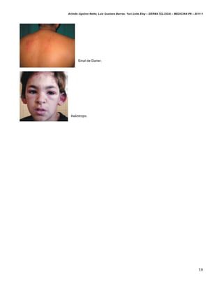 Arlindo Ugulino Netto; Luiz Gustavo Barros; Yuri Leite Eloy – DERMATOLOGIA – MEDICINA P8 – 2011.1




       Sinal de Darier.




 Heliotropo.




                                                                                              18
 