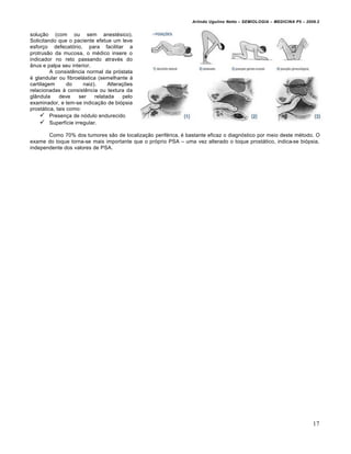 Arlindo Ugulino Netto – SEMIOLOGIA – MEDICINA P5 – 2009.2


solu†•o (com ou sem anest„sico).
Solicitando que o paciente efetue um leve
esfor†o defecat…rio, para facilitar a
protrus•o da mucosa, o m„dico insere o
indicador no reto passando atrav„s do
‡nus e palpa seu interior.
         A consist‰ncia normal da pr…stata
„ glandular ou fibroelƒstica (semelhante •
cartilagem       do    naiz).     Altera†€es
relacionadas • consist‰ncia ou textura da
gl‡ndula     deve    ser    relatada    pelo
examinador, e tem-se indica†•o de bi…psia
prostƒtica, tais como:
     Presen†a de n…dulo endurecido
     Superf‚cie irregular.
       Como 70% dos tumores s•o de localiza†•o perif„rica, „ bastante eficaz o diagn…stico por meio deste m„todo. O
exame do toque torna-se mais importante que o pr…prio PSA – uma vez alterado o toque prostƒtico, indica-se bi…psia,
independente dos valores de PSA.




                                                                                                                      17
 