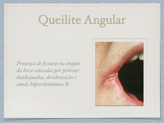 Queilite Angular
Presença de ﬁssuras no ángulo
da boca causadas por próteses
inadequadas, desidratação e
ainda hipovitaminose B.
 