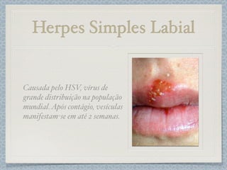 Herpes Simples Labial
Causada pelo HSV, vírus de
grande distribuição na população
mundial.Após contágio, vesículas
manifestam-se em até 2 semanas.
 