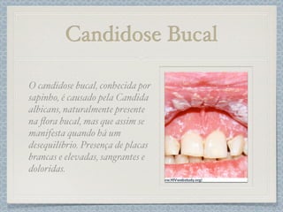 Candidose Bucal
O candidose bucal, conhecida por
sapinho, é causado pela Candida
albicans, naturalmente presente
na ﬂora bucal, mas que assim se
manifesta quando há um
desequilíbrio. Presença de placas
brancas e elevadas, sangrantes e
doloridas.
 