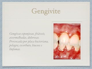 Gengivite
Gengivas esponjosas, #iáveis,
avermelhadas, dolorosas.
Provocada por placa bacteriana,
pelagra, escorbuto, leucose e
linfomas.
 