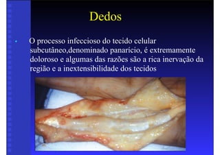Dedos
• O processo infeccioso do tecido celular
subcutâneo,denominado panarício, é extremamente
doloroso e algumas das razões são a rica inervação da
região e a inextensibilidade dos tecidos
 