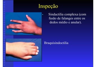 Inspeção
• Sindactilia complexa (com
fusão de falanges entre os
dedos médio e anular).
Braquisindoctilia
 