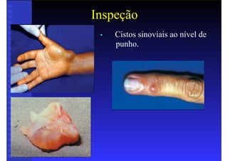 Inspeção
• Cistos sinoviais ao nível de
punho.
 