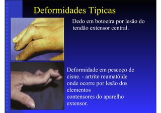 Deformidades Típicas
• Dedo em botoeira por lesão do
tendão extensor central.
Deformidade em pescoço de
cisne. - artrite reumatóide
onde ocorre por lesão dos
elementos
contensores do aparelho
extensor.
 