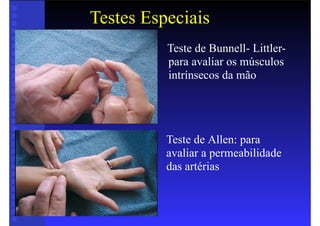 Testes Especiais
• Teste de Bunnell- Littler-
para avaliar os músculos
intrínsecos da mão
Teste de Allen: para
avaliar a permeabilidade
das artérias
 