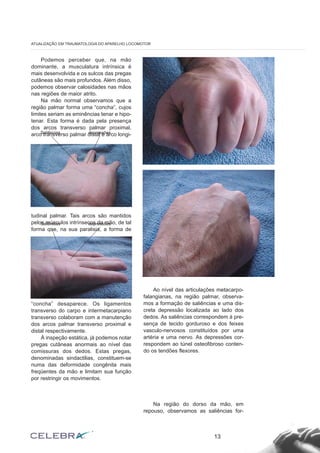 Podemos perceber que, na mão 
dominante, a musculatura intrínsica é 
mais desenvolvida e os sulcos das pregas 
cutâneas são mais profundos. Além disso, 
podemos observar calosidades nas mãos 
nas regiões de maior atrito. 
Na mão normal observamos que a 
região palmar forma uma “concha”, cujos 
limites seriam as eminências tenar e hipo-tenar. 
Esta forma é dada pela presença 
dos arcos transverso palmar proximal, 
arco transverso palmar distal e arco longi-tudinal 
palmar. Tais arcos são mantidos 
pelos músculos intrínsecos da mão, de tal 
forma que, na sua paralisia, a forma de 
“concha” desaparece. Os ligamentos 
transverso do carpo e intermetacarpiano 
transverso colaboram com a manutenção 
dos arcos palmar transverso proximal e 
distal respectivamente. 
À inspeção estática, já podemos notar 
pregas cutâneas anormais ao nível das 
comissuras dos dedos. Estas pregas, 
denominadas sindactilias, constituem-se 
numa das deformidade congênita mais 
freqüentes da mão e limitam sua função 
por restringir os movimentos. 
Ao nível das articulações metacarpo-falangianas, 
na região palmar, observa-mos 
a formação de saliências e uma dis-creta 
depressão localizada ao lado dos 
dedos. As saliências correspondem à pre-sença 
de tecido gorduroso e dos feixes 
vasculo-nervosos constituídos por uma 
artéria e uma nervo. As depressões cor-respondem 
ao túnel osteofibroso conten-do 
os tendões flexores. 
Na região do dorso da mão, em 
repouso, observamos as saliências for- 
13 
ATUALIZAÇÃO EM TRAUMATOLOGIA DO APARELHO LOCOMOTOR 
Saliências depressões 
Saliências depressões 
 