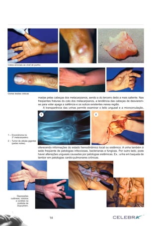 madas pelas cabeças dos metacarpianos, sendo a do terceiro dedo a mais saliente. Nas 
freqüentes fraturas do colo dos metacarpianos, a tendência das cabeças de desviarem-se 
para volar apaga a saliência e os sulcos existentes nessa região. 
A transparência das unhas permite examinar o leito ungueal e a microcirculação, 
14 
Cistos sinoviais ao vivel de punho. 
Outras lesões císticas 
oferecendo informações do estado hemodinâmico local ou sistêmico. A unha também é 
sede freqüente de patologias infecciosas, bacterianas e fúngicas. Por outro lado, pode 
haver alterações ungueais causadas por patologias sistêmicas. Ex.: unha em baqueta de 
tambor em patologias cardio-pulmonares crônicas. 
1 – Encondroma no 
3º metacarpeâno. 
2 – Tumor de células gigantes 
(partes moles). 
Depressões 
cutâneas, nódulos 
e cordões na 
moléstia de 
Dupuytrem. 
1 2 
 