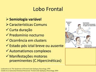 Lobo Frontal
Semiologia variável
Características Comuns
Curta duração
Predomínio nocturno
Ocorrência em clusters
Estado pós ictal breve ou ausente
Automatismos complexos
Manifestações motoras
proeminentes (C.Hipercinéticas)
Laskowitz et al. The Syndrome of Frontal Lobe Epilepsy, Neurology, 1995
Combi et al. Autosomal Dominat Nocturnal Frontal Lobe Epilepsy, J Neurology, 2004
 