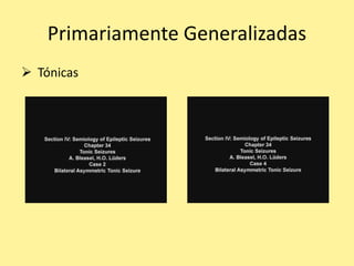 Primariamente Generalizadas
 Tónicas
 