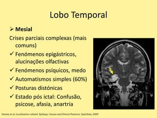 Lobo Temporal
 Mesial
Crises parciais complexas (mais
comuns)
 Fenómenos epigástricos,
alucinações olfactivas
 Fenómenos psíquicos, medo
 Automatismos simples (60%)
 Posturas distónicas
 Estado pós ictal: Confusão,
psicose, afasia, anartria
Semim et al. Localization-related Epilepsy: Causes and Clinical Features. UptoDate, 2009
 