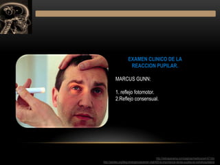 EXAMEN CLINICO DE LA
REACCION PUPILAR.
MARCUS GUNN:
1. reflejo fotomotor.
2.Reflejo consensual.

llhttp://retinapanama.com...
