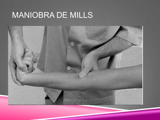 MANIOBRA DE MILLS
 