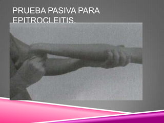 PRUEBA PASIVA PARA
EPITROCLEITIS.
 