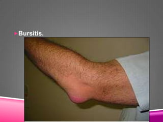 Bursitis.
 