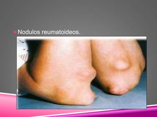 Nodulos reumatoideos.
 
