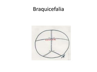 Braquicefalia
 