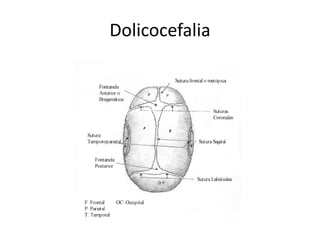 Dolicocefalia
 