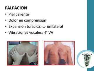 PALPACION
• Piel caliente
• Dolor en comprensión
• Expansión torácica: ↓ unilateral
• Vibraciones vocales: ↑ VV
 