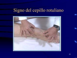 Signo del cepillo rotuliano
10
 