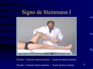 Signo de Steinmann I
12
Flexión + rotación externa máxima = lesión en menisco interno
Flexión + rotación interna máxima = lesión menisco externo
 