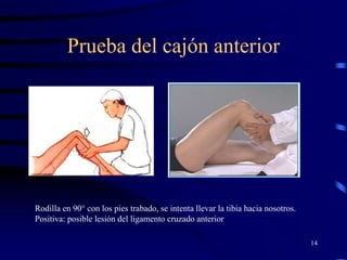 Prueba del cajón anterior
14
Rodilla en 90° con los pies trabado, se intenta llevar la tibia hacia nosotros.
Positiva: posible lesión del ligamento cruzado anterior
 
