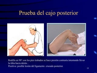 Prueba del cajo posterior
15
Rodilla en 90° con los pies trabados se hace presión contraria intentando llevar
la tibia hacia detrás .
Positiva: posible lesión del ligamento cruzado posterior.
 