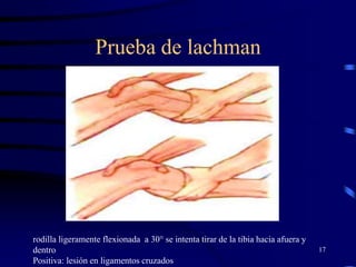Prueba de lachman
17
rodilla ligeramente flexionada a 30° se intenta tirar de la tibia hacia afuera y
dentro
Positiva: lesión en ligamentos cruzados
 